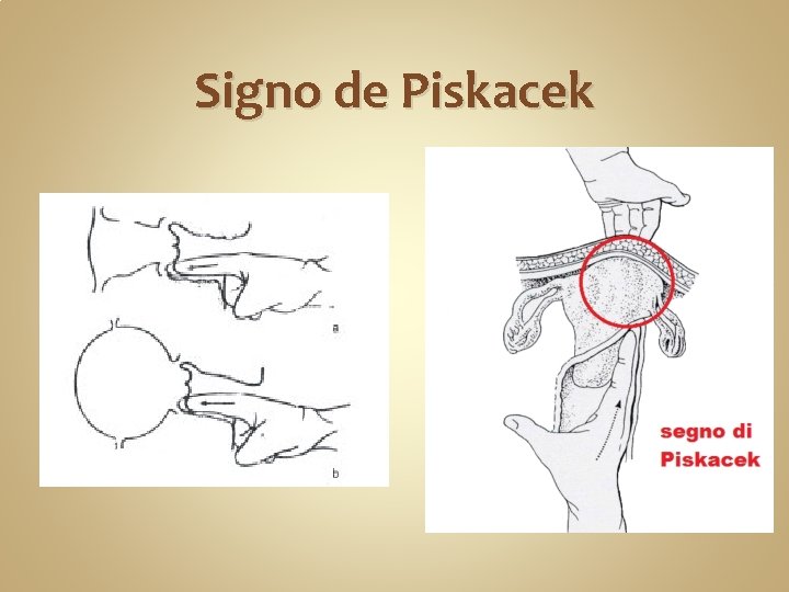 Signo de Piskacek 