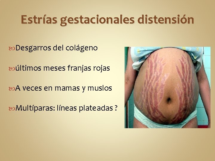 Estrías gestacionales distensión Desgarros del colágeno últimos meses franjas rojas A veces en mamas