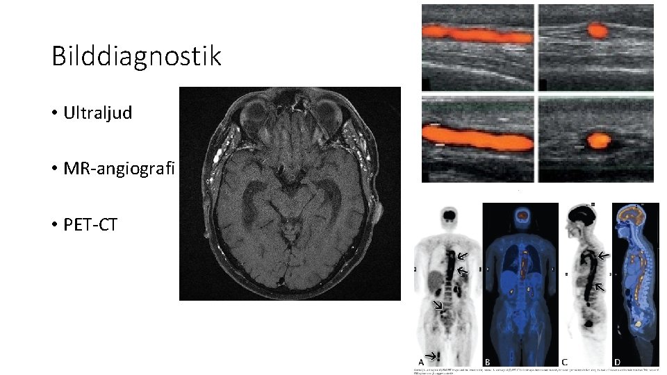 Bilddiagnostik • Ultraljud • MR-angiografi • PET-CT 