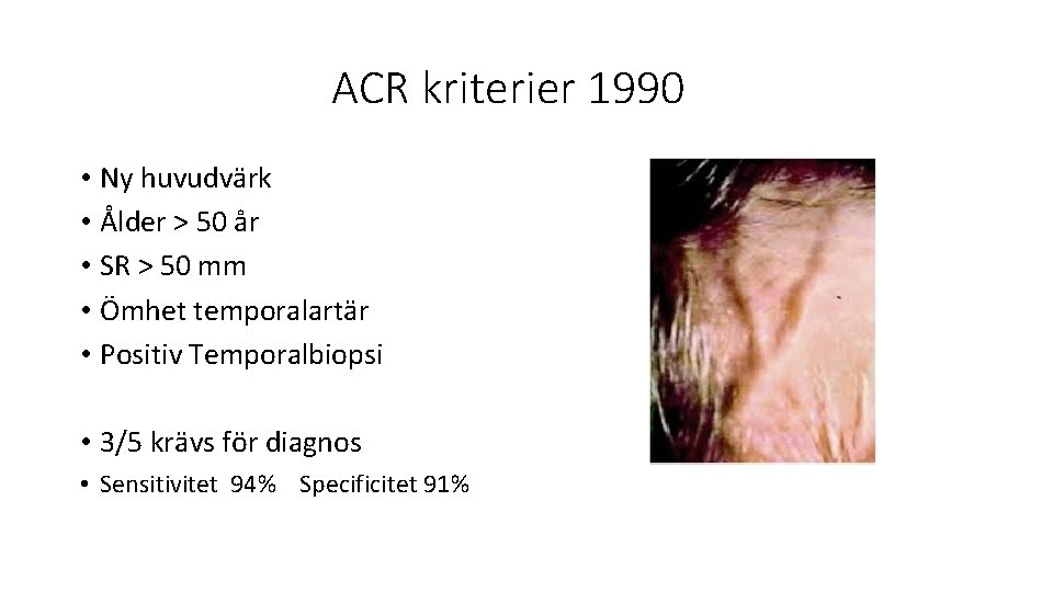 ACR kriterier 1990 • Ny huvudvärk • Ålder > 50 år • SR >
