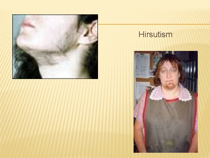 Hirsutism 