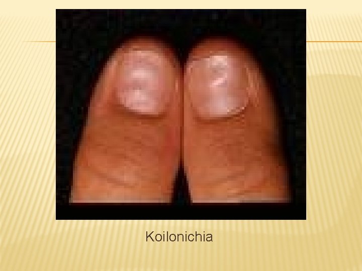 Koilonichia 