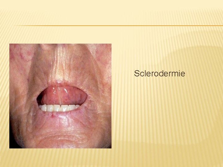 Sclerodermie 