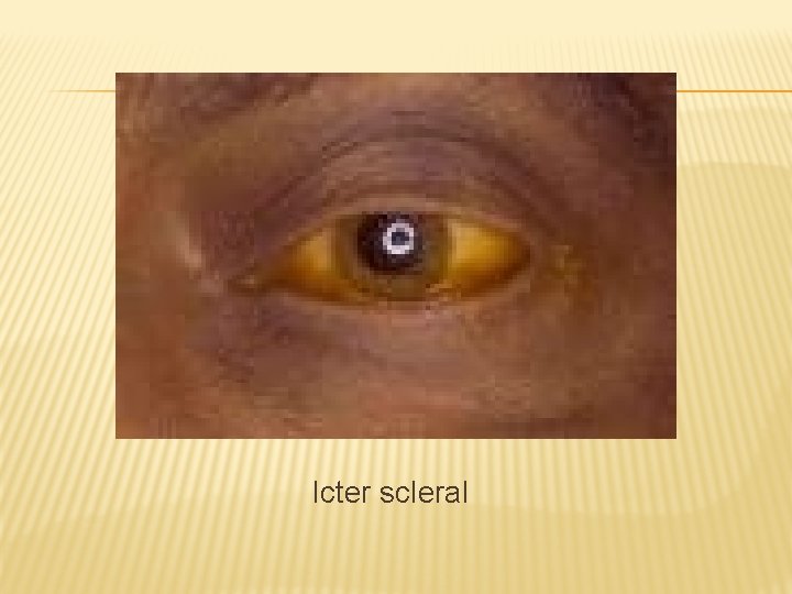 Icter scleral 