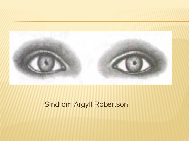 Sindrom Argyll Robertson 