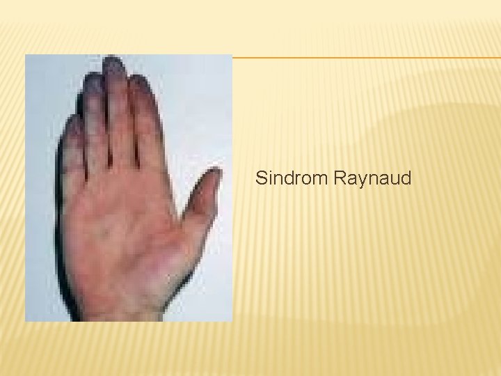 Sindrom Raynaud 