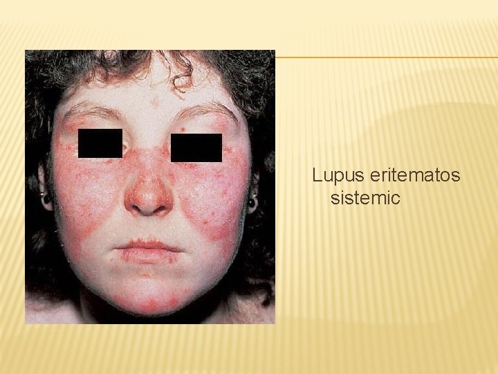 Lupus eritematos sistemic 