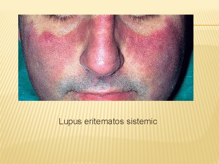 Lupus eritematos sistemic 