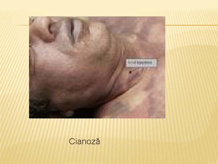  Cianoză 