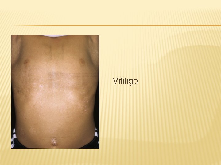 Vitiligo 