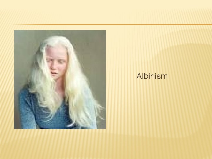 Albinism 