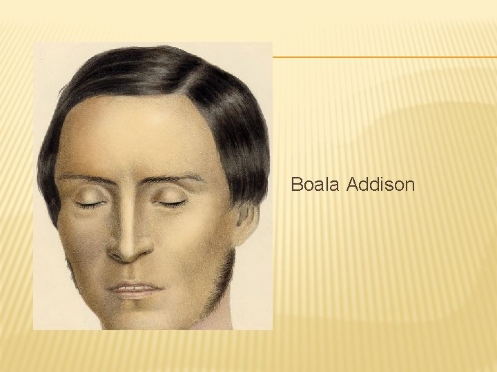 Boala Addison 