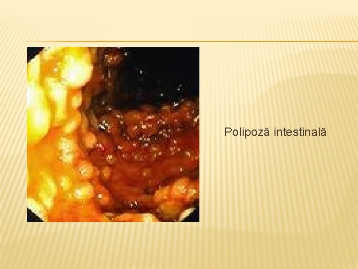 Polipoză intestinală 