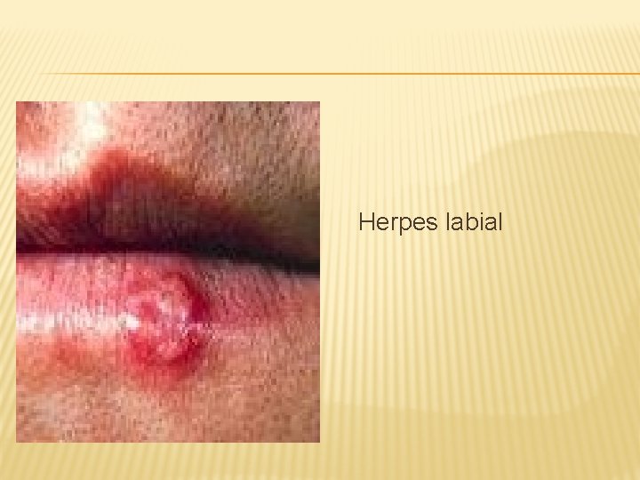 Herpes labial 