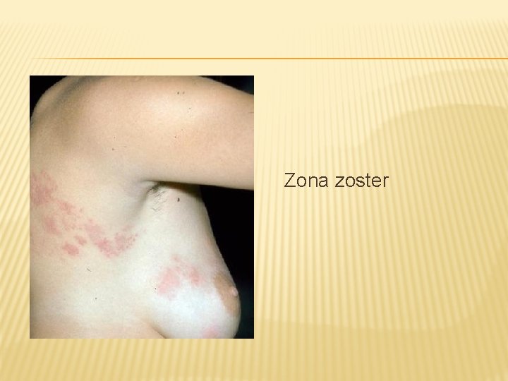 Zona zoster 