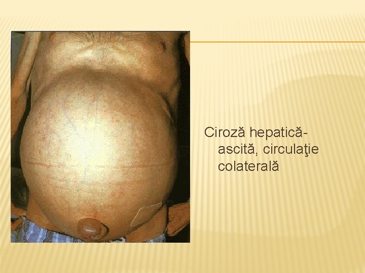 Ciroză hepatică- ascită, circulaţie colaterală 