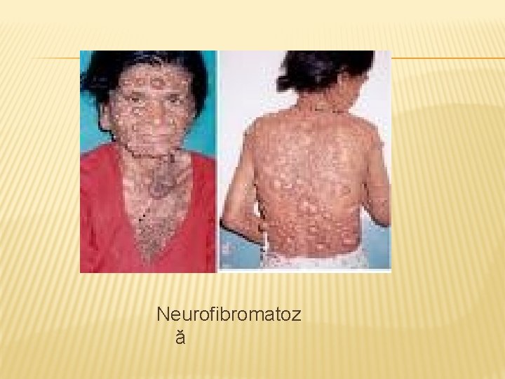 Neurofibromatoz ă 