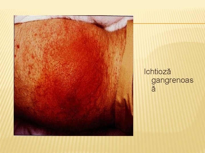 Ichtioză gangrenoas ă 