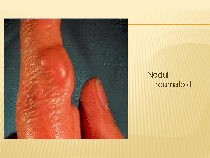 Nodul reumatoid 