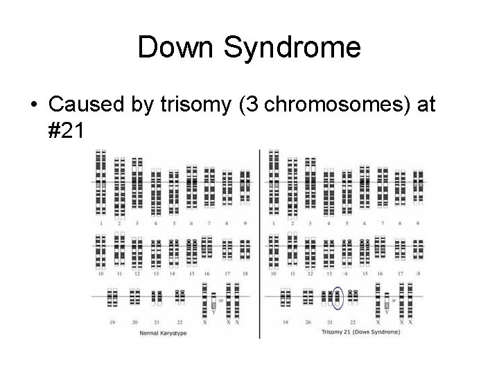 Down Syndrome • Caused by trisomy (3 chromosomes) at #21 Down Syndrome • Caused by trisomy (3 chromosomes) at #21