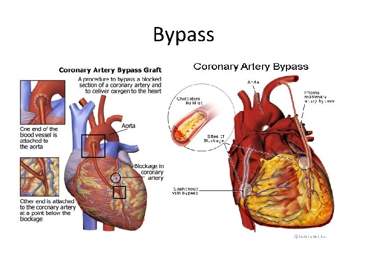 Bypass 