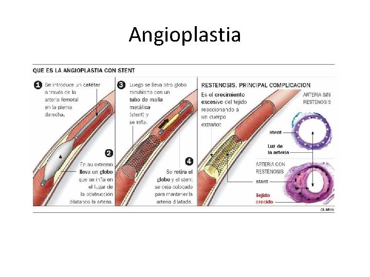 Angioplastia 