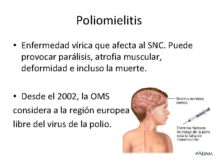 Poliomielitis • Enfermedad vírica que afecta al SNC. Puede provocar parálisis, atrofia muscular, deformidad