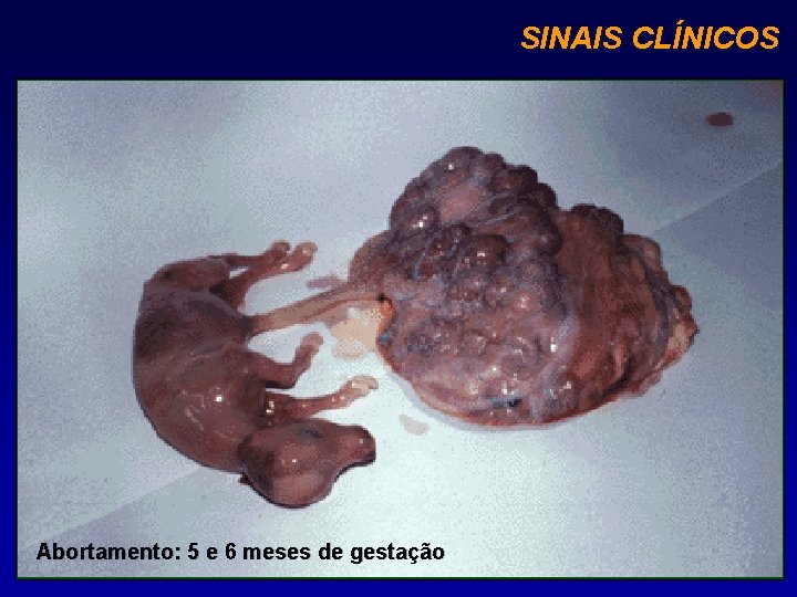 SINAIS CLÍNICOS Abortamento: 5 e 6 meses de gestação 