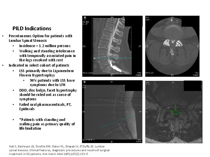 PILD Indications • • Percutaneous Option for patients with Lumbar Spinal Stenosis • Incidence