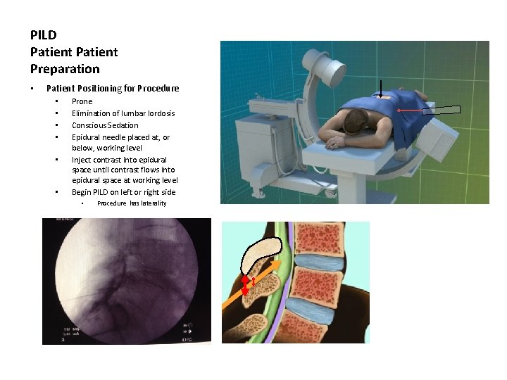 PILD Patient Preparation • Patient Positioning for Procedure • • • Prone Elimination of