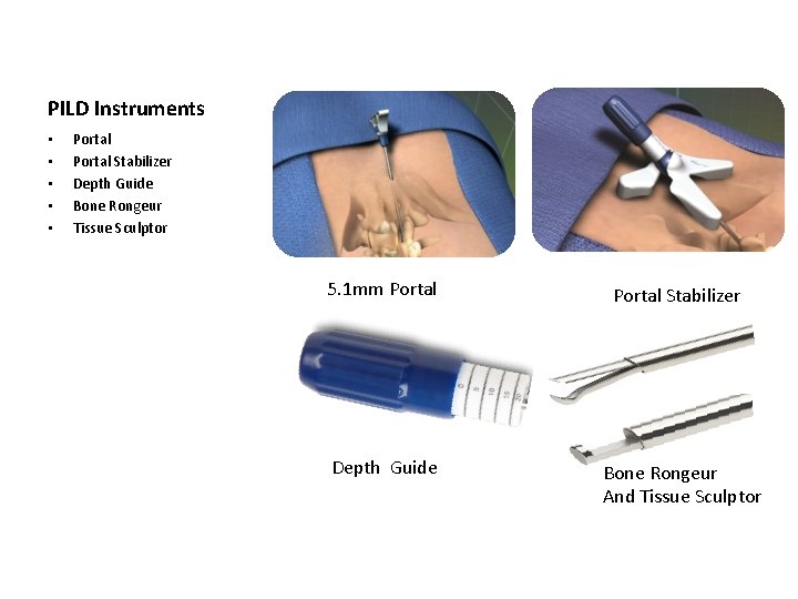 PILD Instruments • • • Portal Stabilizer Depth Guide Bone Rongeur Tissue Sculptor 5. PILD Instruments • • • Portal Stabilizer Depth Guide Bone Rongeur Tissue Sculptor 5.