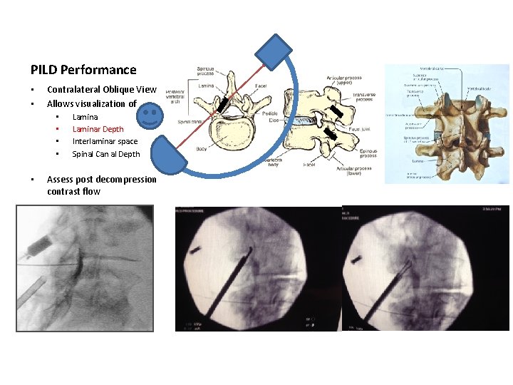 PILD Performance • • Contralateral Oblique View Allows visualization of • • • Laminar