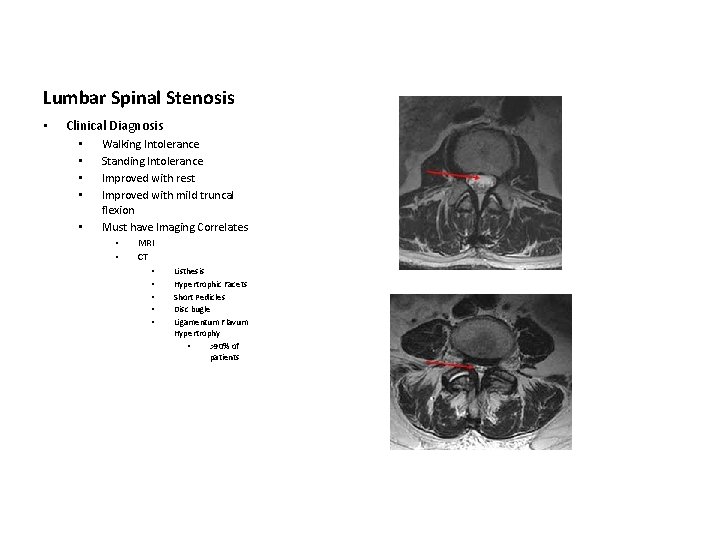 Lumbar Spinal Stenosis • Clinical Diagnosis • • • Walking Intolerance Standing Intolerance Improved