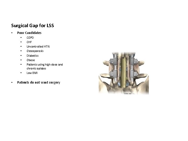 Surgical Gap for LSS • Poor Candidates • • • COPD CHF Uncontrolled HTN