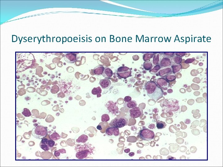 Dyserythropoeisis on Bone Marrow Aspirate 