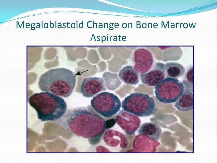 Megaloblastoid Change on Bone Marrow Aspirate 