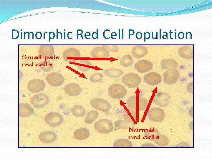 Dimorphic Red Cell Population 