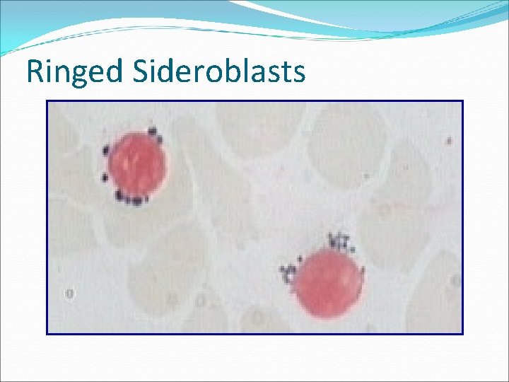 Ringed Sideroblasts 