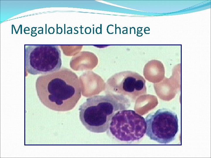 Megaloblastoid Change 