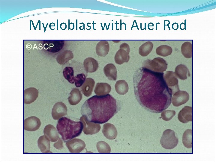 Myeloblast with Auer Rod 