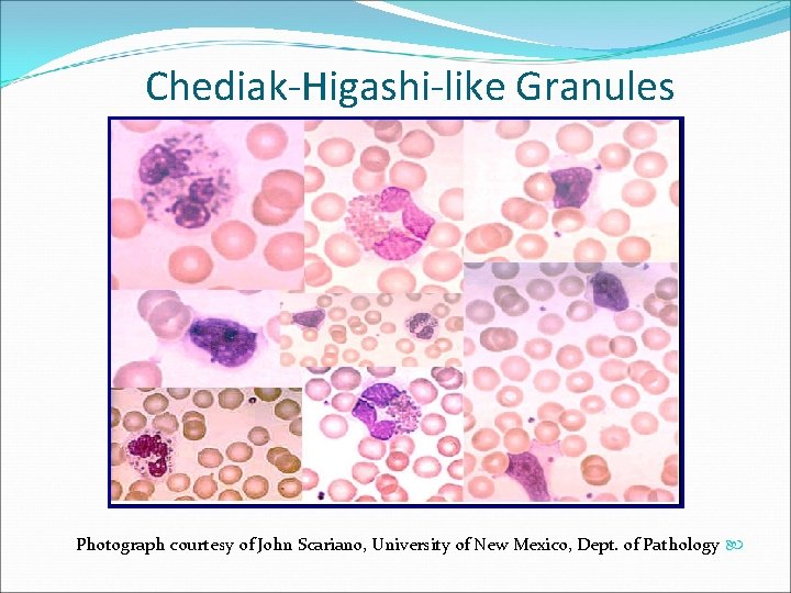 Chediak-Higashi-like Granules Photograph courtesy of John Scariano, University of New Mexico, Dept. of Pathology