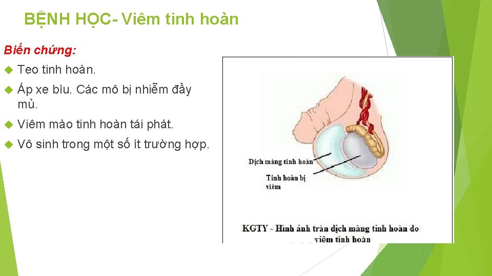 BỆNH HỌC- Viêm tinh hoàn Biến chứng: Teo tinh hoàn. Áp xe bìu. Các