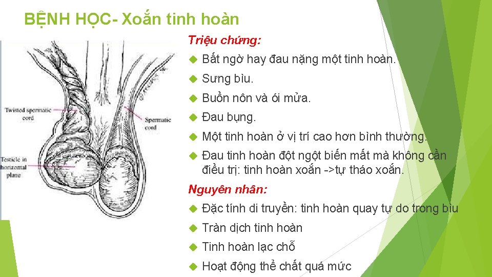 BỆNH HỌC- Xoắn tinh hoàn Triệu chứng: Bất ngờ hay đau nặng một tinh