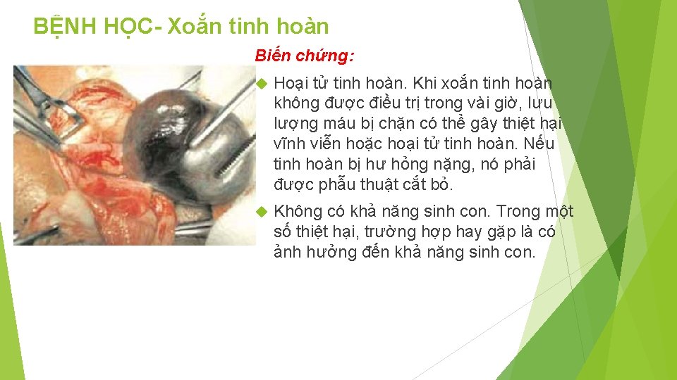 BỆNH HỌC- Xoắn tinh hoàn Biến chứng: Hoại tử tinh hoàn. Khi xoắn tinh