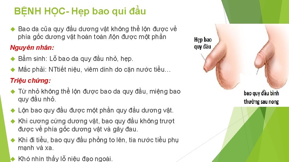 BỆNH HỌC- Hẹp bao qui đầu Bao da của quy đầu dương vật không
