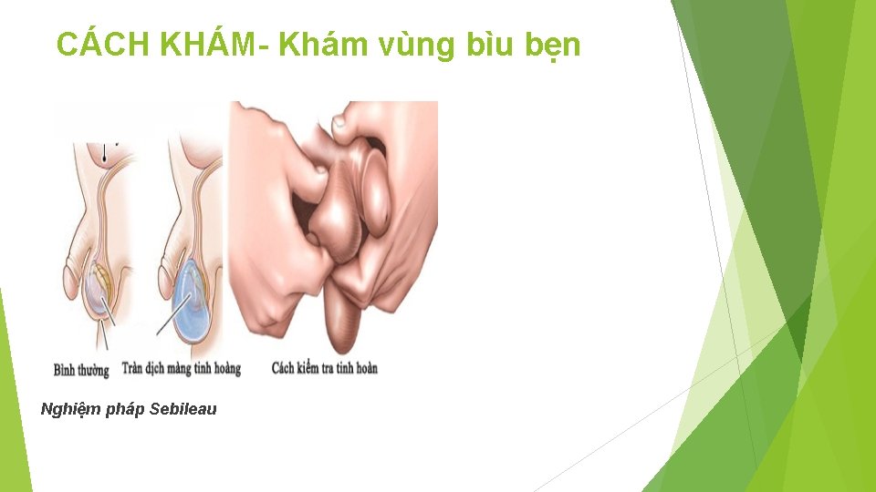 CÁCH KHÁM- Khám vùng bìu bẹn Nghiệm pháp Sebileau 