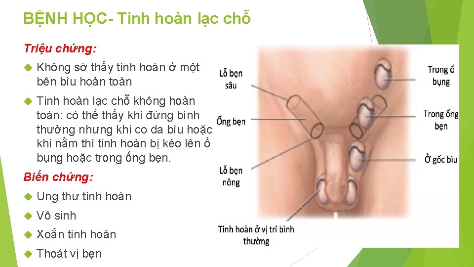 BỆNH HỌC- Tinh hoàn lạc chỗ Triệu chứng: Không sờ thấy tinh hoàn ở