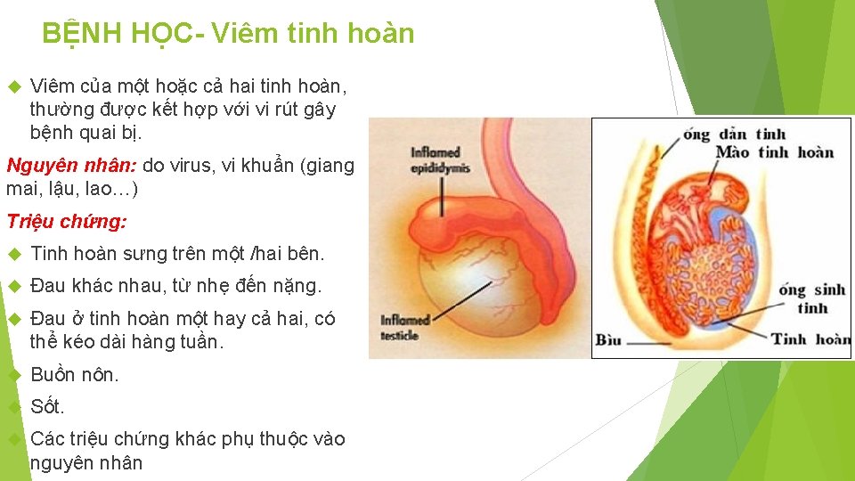 BỆNH HỌC- Viêm tinh hoàn Viêm của một hoặc cả hai tinh hoàn, thường