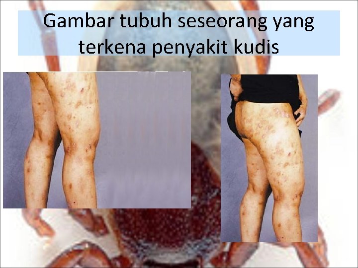 Gambar tubuh seseorang yang terkena penyakit kudis 