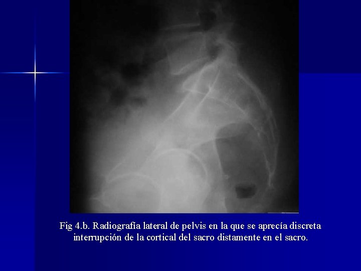 Fig 4. b. Radiografía lateral de pelvis en la que se aprecía discreta interrupción